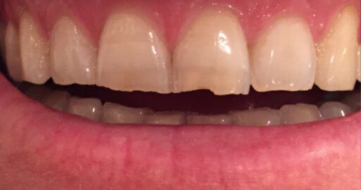 Teeth-5-Before